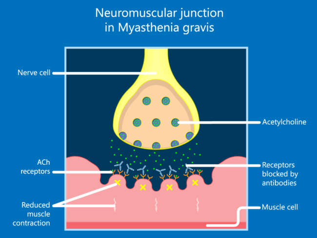 Illustration of neuromuscular junction in myasthenia gravis