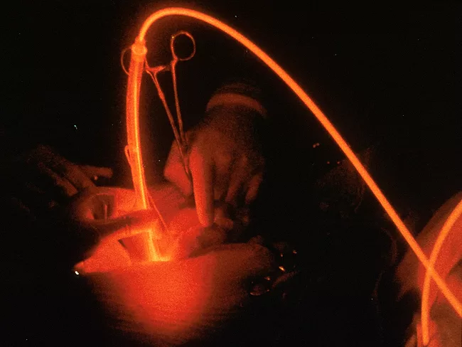 Doctor using fiber-optic probe to expose cancer to laser light