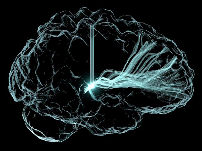 Artistic rendering of deep brain stimulation.