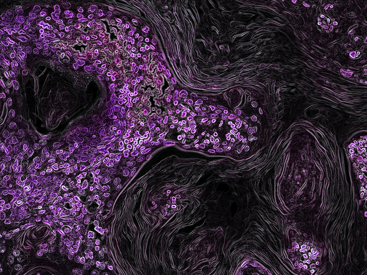 Lung cancer driven by the Kras oncogene shown in purple