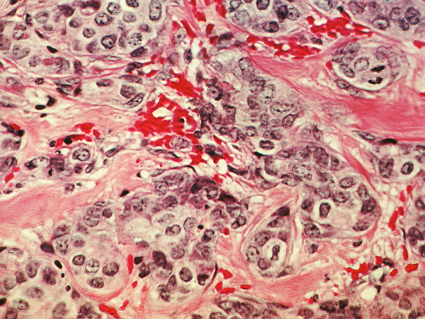 Early development of Olema and Aurigene’s OP-3136 for breast cancer