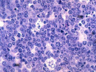 Malignant B-cell lymphocytes seen in Burkitt lymphoma, stained with hematoxylin and eosin (H&E) stain.