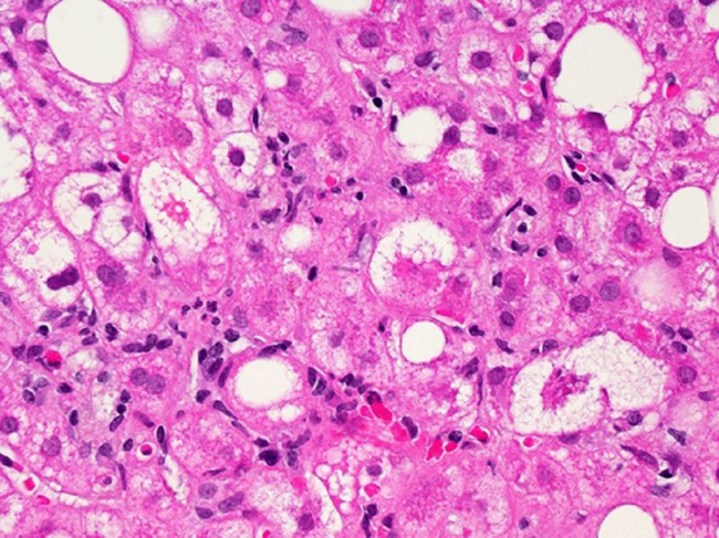 A microscopic image of liver tissue affected by nonalcoholic fatty liver disease.