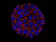 Pancreatic cancer cells.