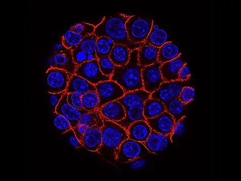 Pancreatic cancer cells.