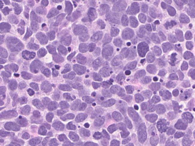Small-cell lung carcinoma cells under the microscope