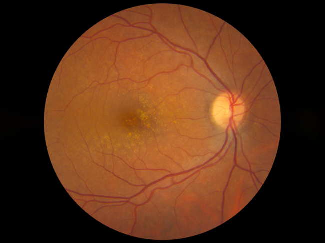 Fundus image of eye with age-related macular degeneration.