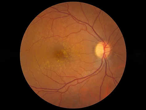 Nih nei amd retina eye