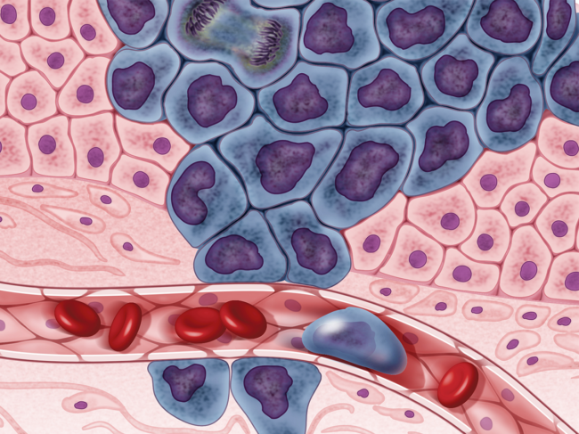 Illustration of cancer cells entering the bloodstream.