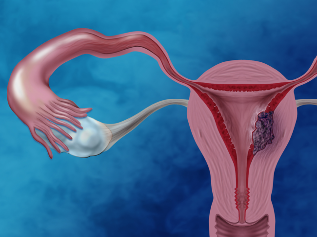 Illustration of ovary, uterus and endometrial cancer.