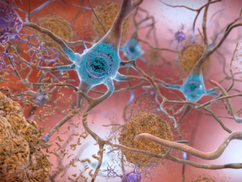 Illustration of Alzheimer’s in the brain.