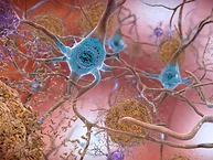Illustration of Alzheimer’s in the brain.