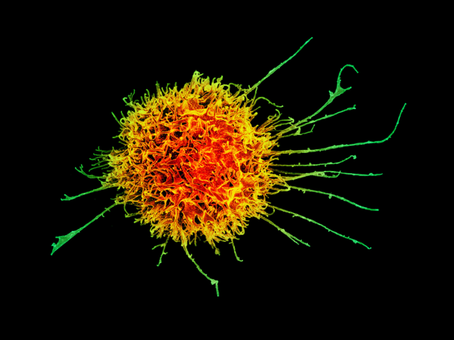 Colorized scanning electron micrograph of a human natural killer cell.