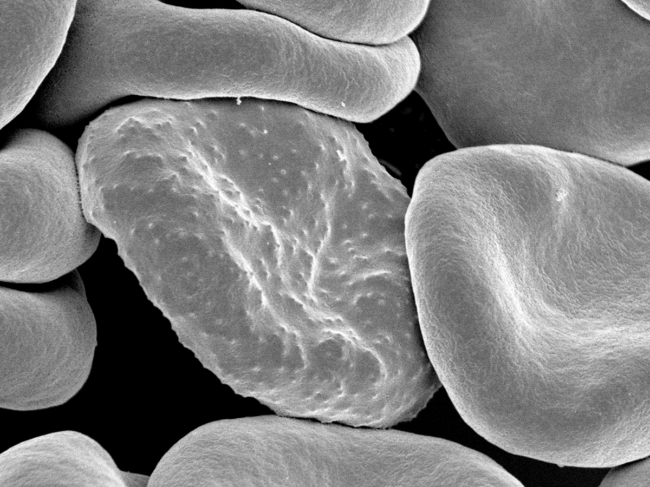 Electron micrograph of red blood cell infected with Plasmodium falciparum surrounded by knobless uninfected blood cells.