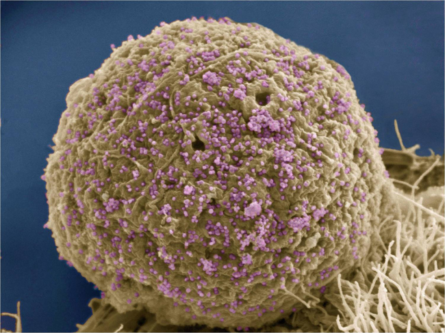 HIV infected cell.