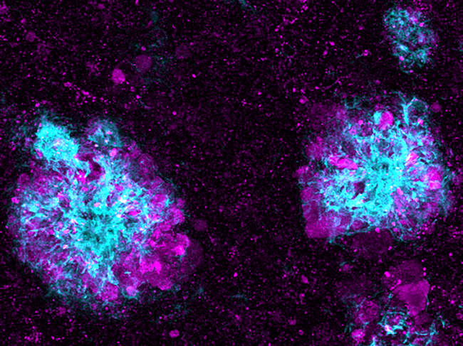 Lysosome clusters in a mouse model of Alzheimer's disease.