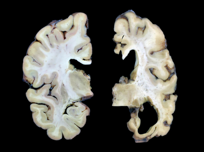 Coronal plane slices of the brain comparing normal to Alzheimer’s.