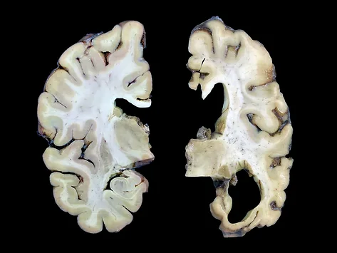 Normal and ad brain slices