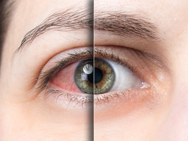 Close up of eye before and after treatment