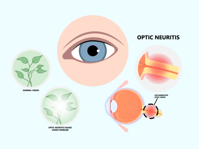 Art concept for optic neuritis