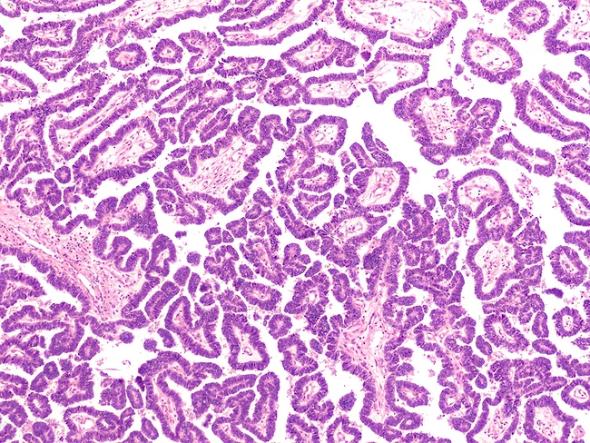 Micrograph of a serous papillary carcinoma (adenocarcinoma) of ovary
