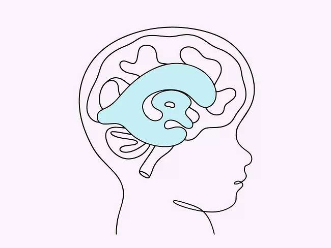 Illustration of brain in child with hydrocephalus