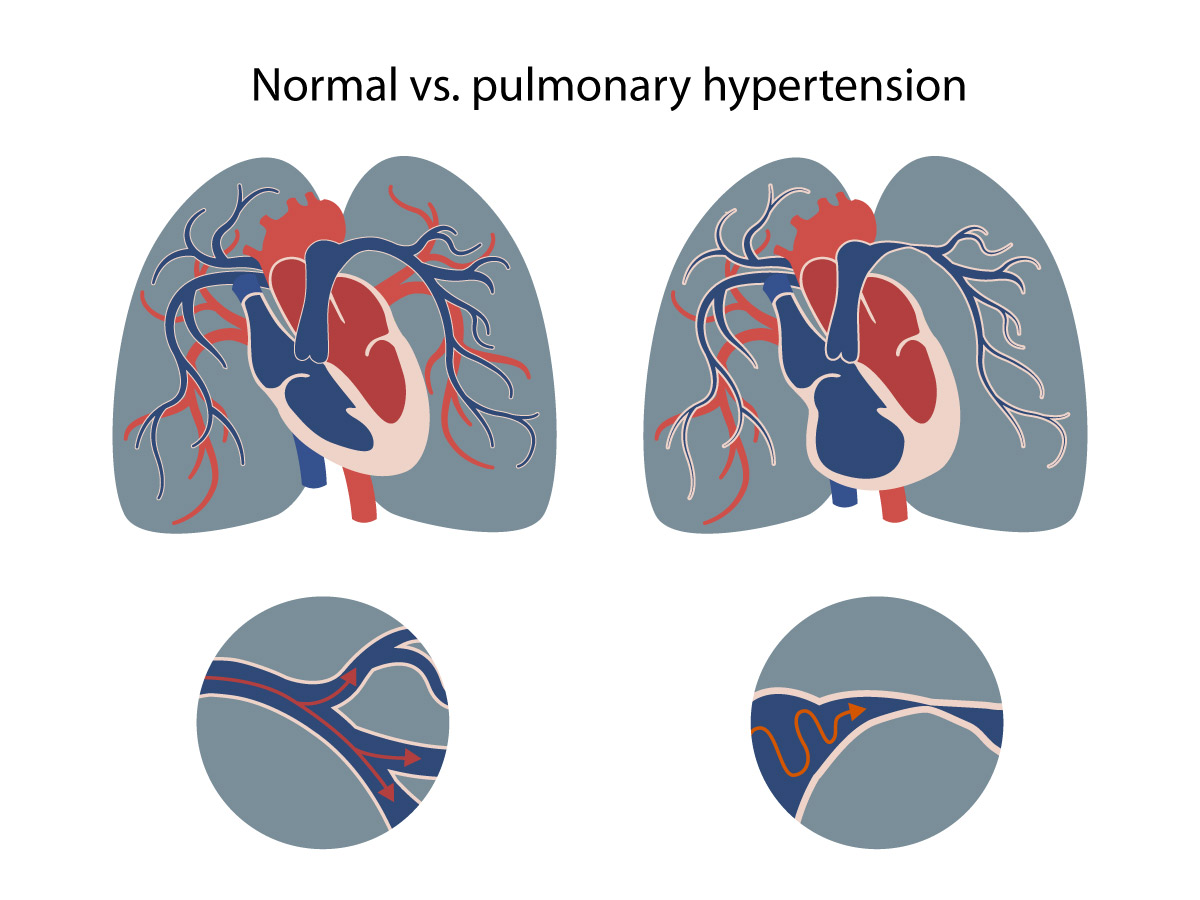 pulmonary artery hypertension
