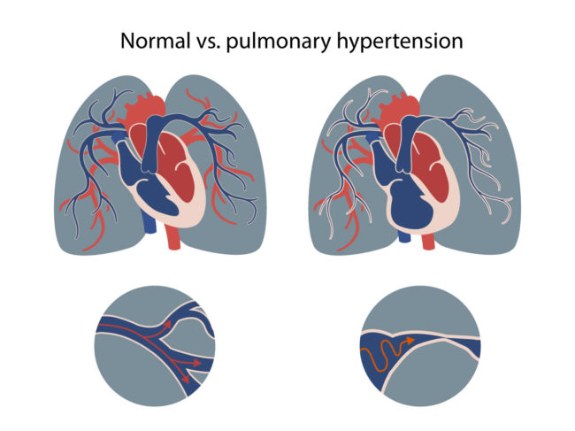 Illustration of heart and lung vasculature in pulmonary hypertension vs. normal