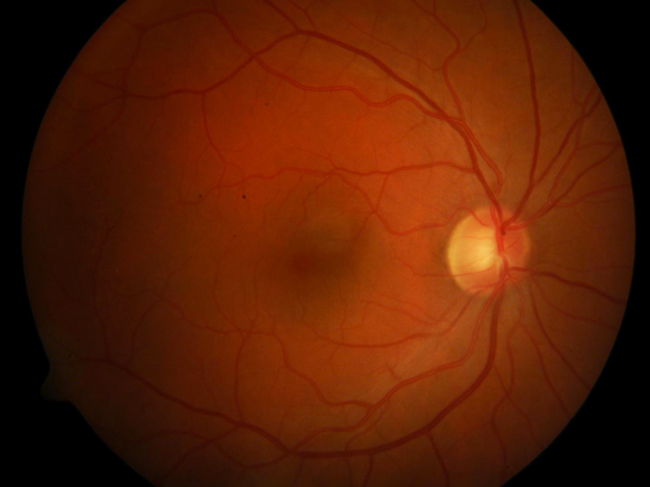 A fundus image of a healthy retina.