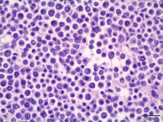 Multiple myeloma cells in the bone marrow.
