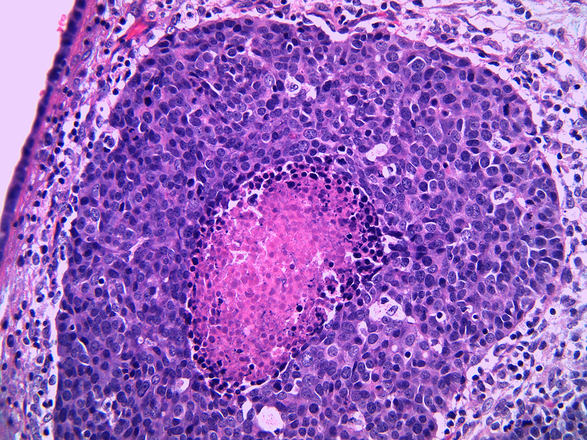 Microscopic view of of high grade urothelial carcinoma of the ureter in a man. 