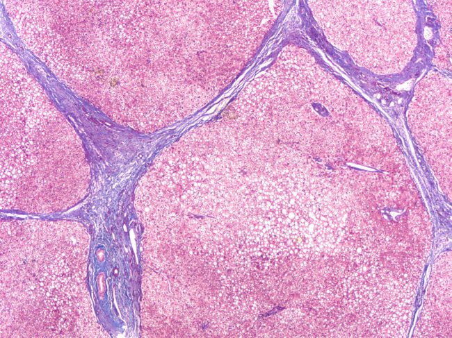 Photomicrograph of liver biopsy in a patient with cirrhosis, showing bridging septal fibrosis and regenerative nodules. 