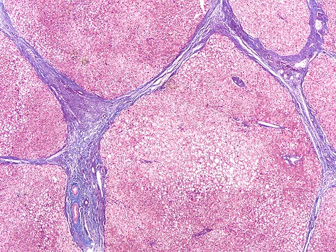 Liver cirrhosis fibrosis