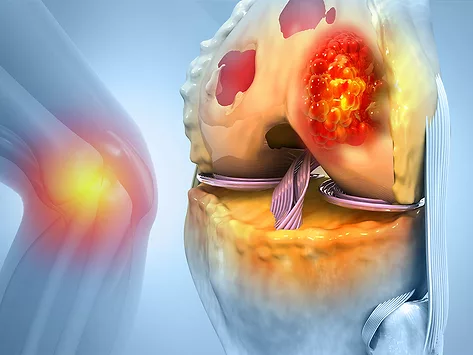 Illustration of bone cancer in the knee