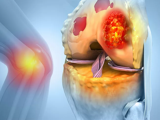 Illustration of bone cancer in the knee