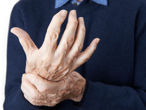Rheumatoid arthritis aging hands