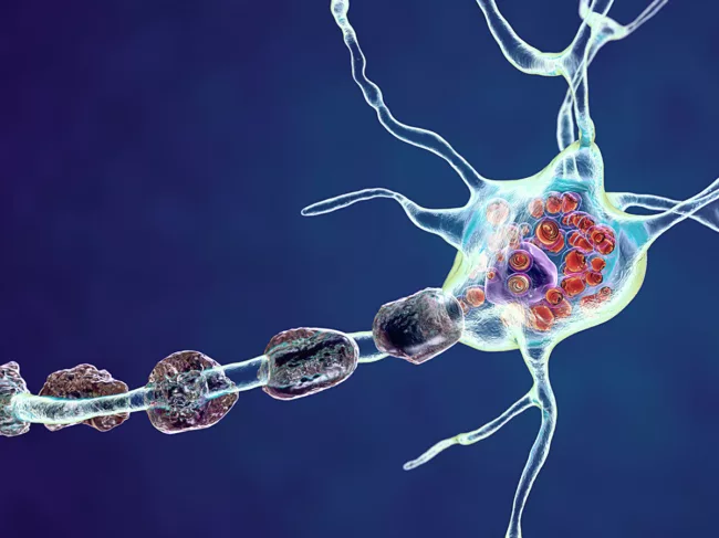 3D illustration of brain neuron in lysosomal storage diseases
