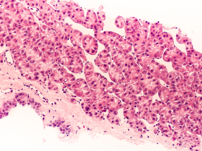 Photomicrograph of hepatocellular carcinoma