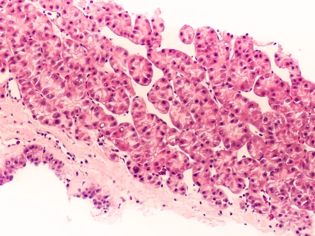 Photomicrograph of hepatocellular carcinoma