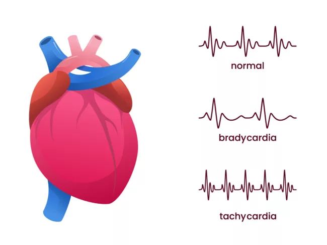 Illustration of heart comparing normal heart beat to bradycardia and tachycardia