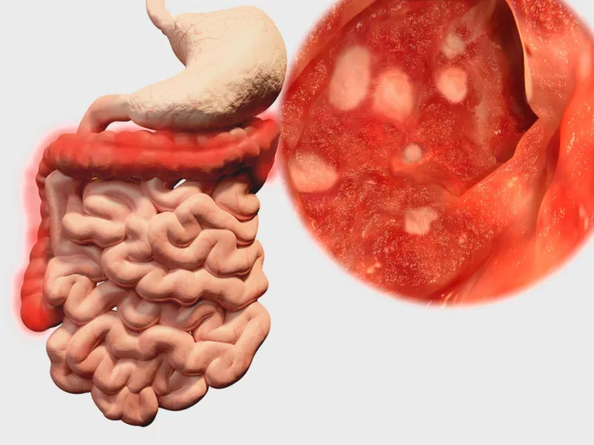 Gastrointestinal system with ulcerative colitis.