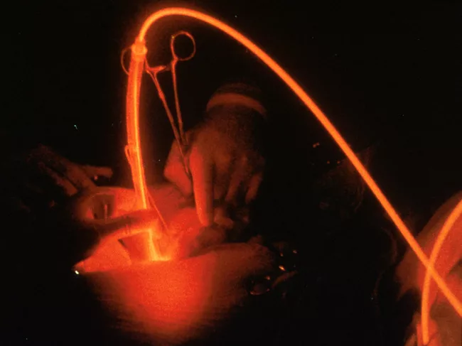 Doctor using fiber-optic probe to expose cancer to laser light