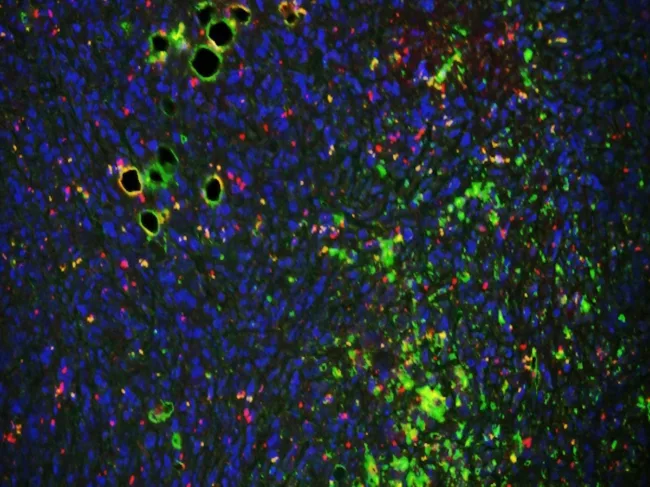 Breast cancer cells.