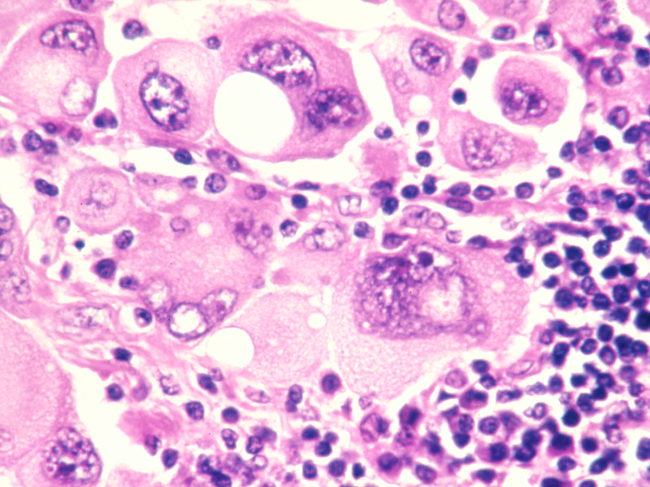 Melanoma cells stained with an H & E stain and magnified to 320x.
