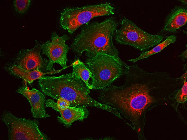 Nanoparticles in cancer cells.