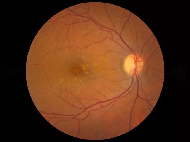Fundus image of eye with age-related macular degeneration.