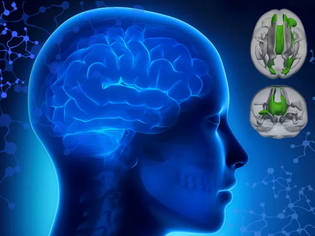 Attention deficit hyperactivity disorder brain connections illustration.