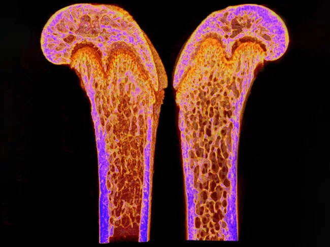 Dlx3 deletion in osteoblast progenitors induce increased trabecular bone formation