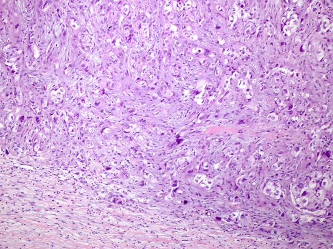 Histology slide of osteosarcoma