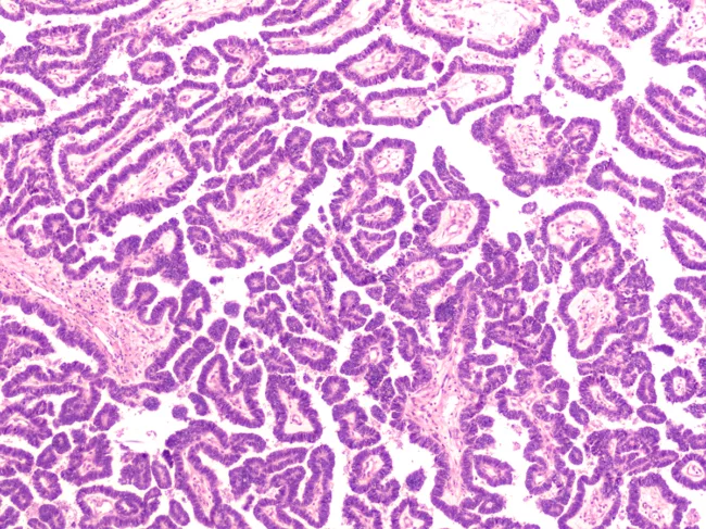 Micrograph of a serous papillary carcinoma (adenocarcinoma) of ovary